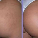 Tratamento de Estrias com Micropuntura